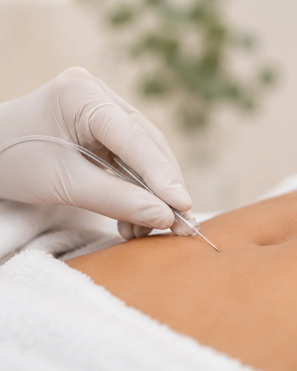 Carboxiterapia. Imagen ilustrativa